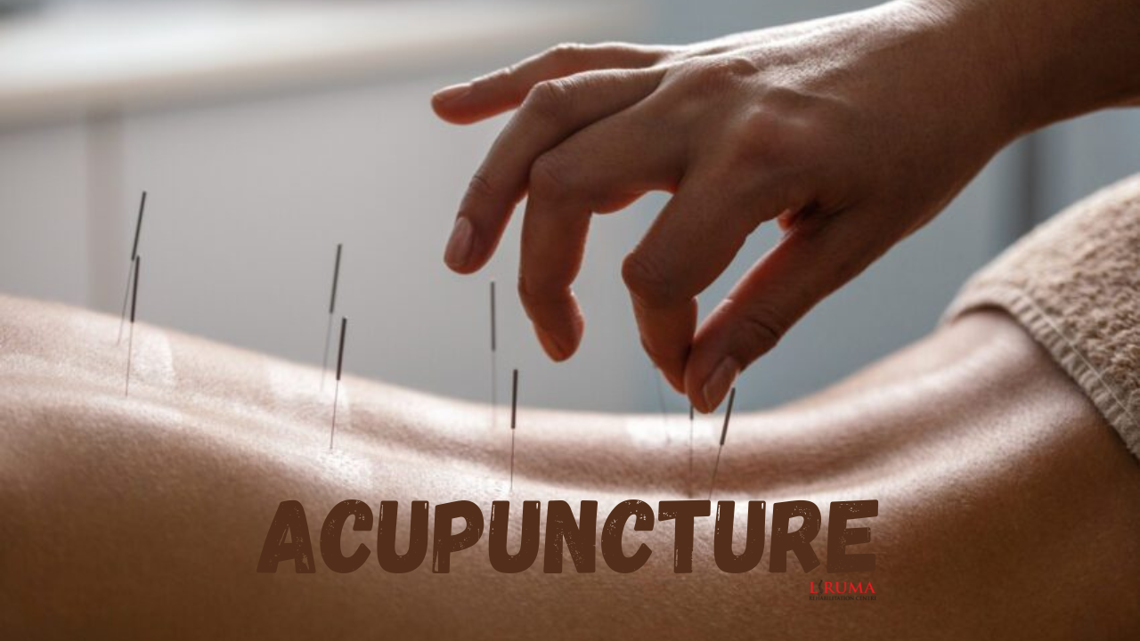 ACUPUNCTURE