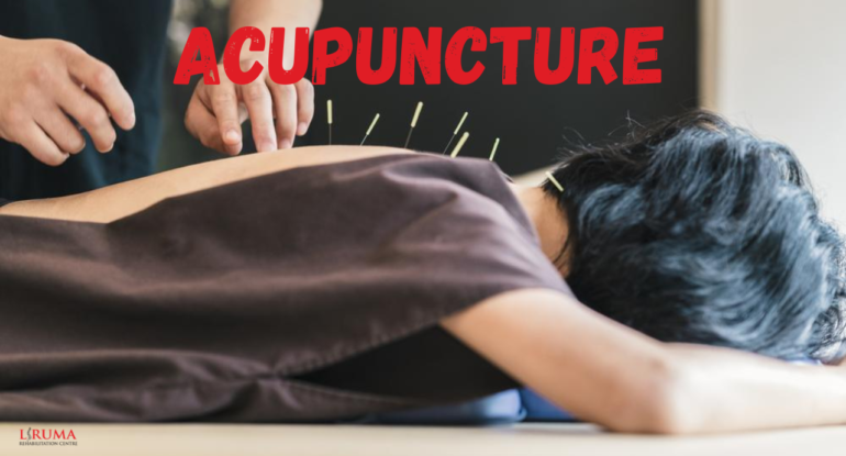 acupuncture