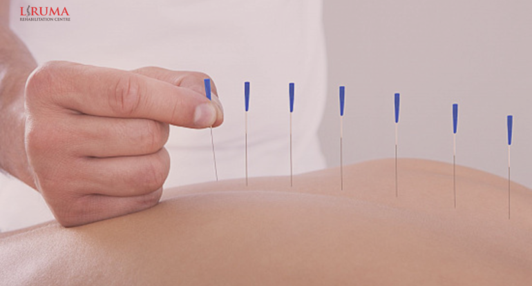ACUPUNCTURE