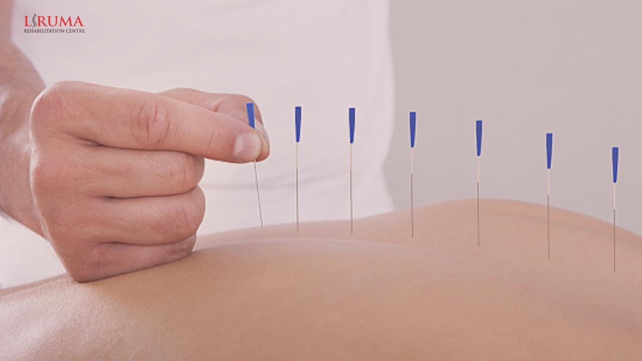 ACUPUNCTURE