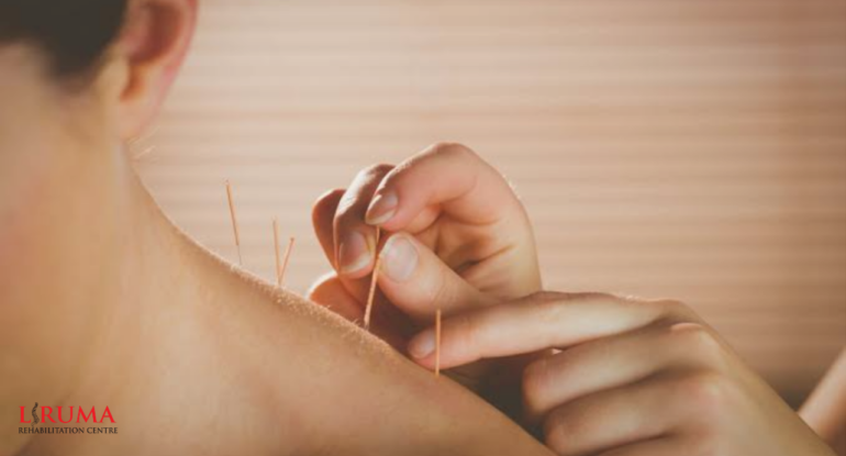 ACUPUNCTURE