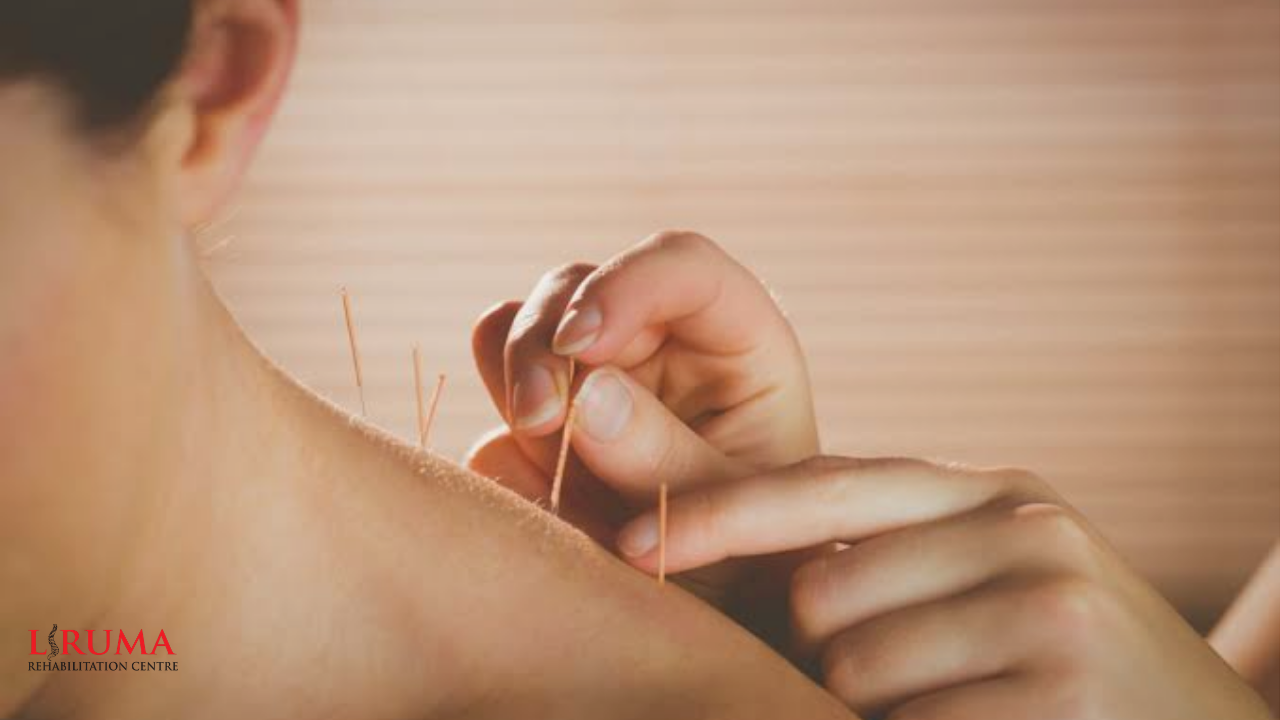 ACUPUNCTURE